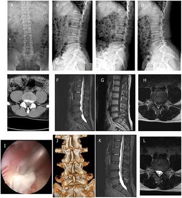 The Learning Curve of Unilateral Biportal Endoscopic (UBE) Spinal Surgery by CUSUM Analysis